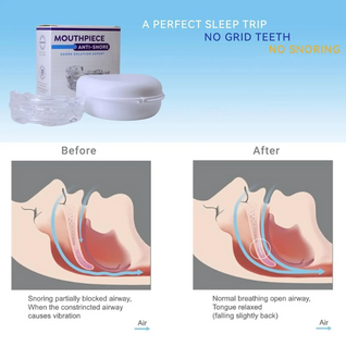 Sleepfx® anti-snoring device